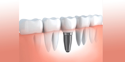 dental implant
