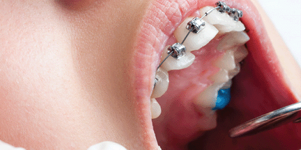 Orthodontic Treatment