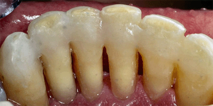 Splinting of Loose Teeth