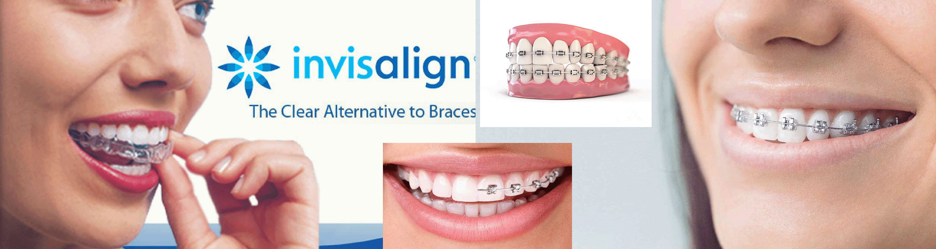 braces