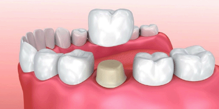 dental_crowns
